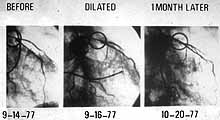 before / after of 1st PTCA patient