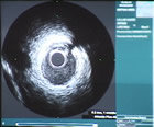 intravascular ultrasound image