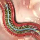 Medtronic Resolute Integrity Drug-Eluting Stent