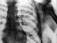 first x-ray of catheterization