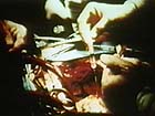 1st intraoperative angioplasty performed in San Francisco
