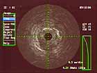 IVUS imaging