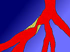 drawing of blockage